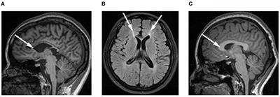 Case report: High-frequency repetitive transcranial magnetic stimulation for treatment of hereditary spastic paraplegia type 11